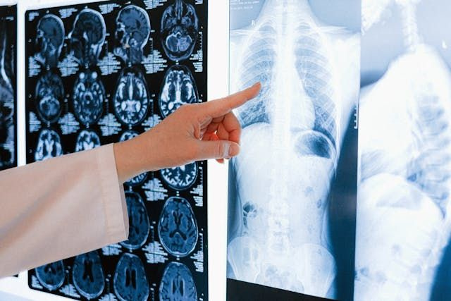 doctor pointing at X-ray scan